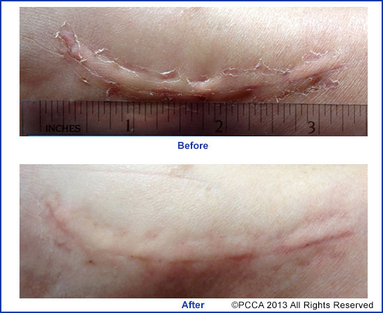 pcca_pic4