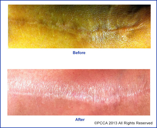 pcca_pic6